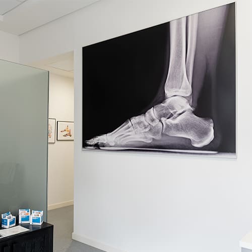 Cirugia del pie en Gijón